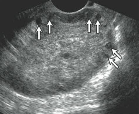 best test for ovarian torsion|ovarian torsion precautions patient education.